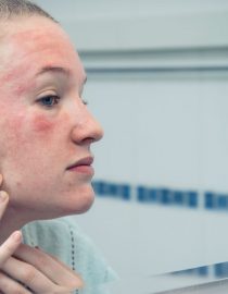 Does Fibromyalgia Cause Skin Issues? Does Fibromyalgia Cause Skin Issues?