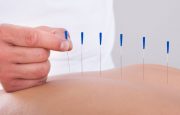 Acupuncture for Fibromyalgia