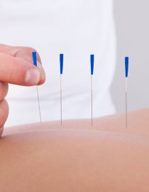 Trying Acupuncture for Fibromyalgia Treatment Trying Acupuncture for Fibromyalgia Treatment