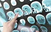 Top 10 NLO | Fibromyalgia Articles of 2014